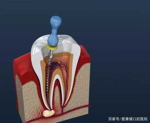 烂神经后牙齿还有用吗（烂了神经的牙齿能保留多久）