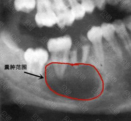 根尖囊肿什么药有用（根尖囊肿怎么缓解）