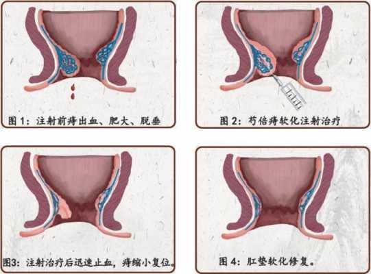 痔疮微创治疗有用吗（痔疮微创治疗有用吗女性）