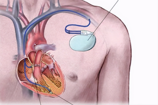 起搏器真的有用吗（起搏器真的有用吗能用多久）