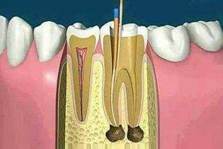 牙疼去钻孔有用吗（牙疼钻洞原理是什么）