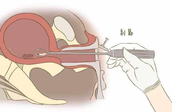 刮宫止血有没有用（刮宫止血有什么危害）