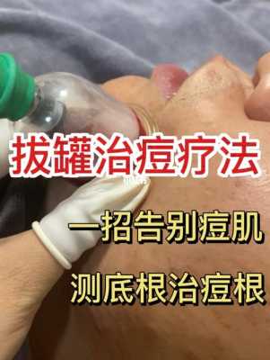 长痘痘拔罐有用（长痘痘 拔罐）