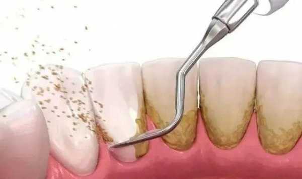 牙龈炎洗牙有用吗（牙龈炎洗牙有用吗多少钱）