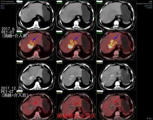 PET检查肝癌有用吗（petct能查肝癌吗）