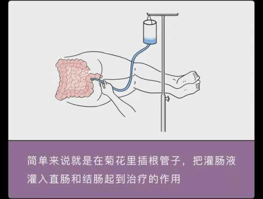 便秘灌肠有用吗（便秘灌肠有什么副作用）