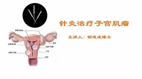 很大的子宫肌瘤针灸有用吗（很大的子宫肌瘤针灸有用吗女性）