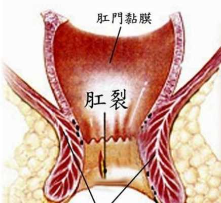 没有用力就肛裂了（肛裂一使劲又裂开了）