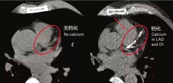 钙化后化疗有用吗（化疗后钙化灶）