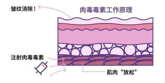 肉毒素有用（肉毒素用处）