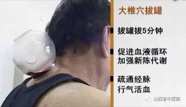 大椎放血治疗痘痘有用吗（大椎放血拔罐治疗痤疮多久一次）