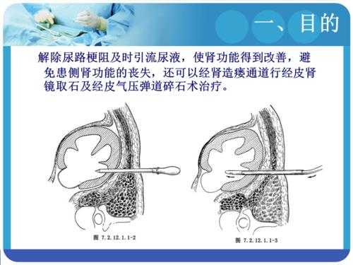 肾造瘘能有用（肾脏造瘘术会恢复肾脏功能吗）