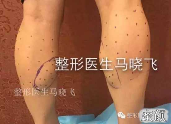 肉毒素瘦腿有用吗（肉毒素瘦腿点位图）