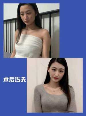 25岁以后丰胸有用吗（25岁以后丰胸有用吗女生）