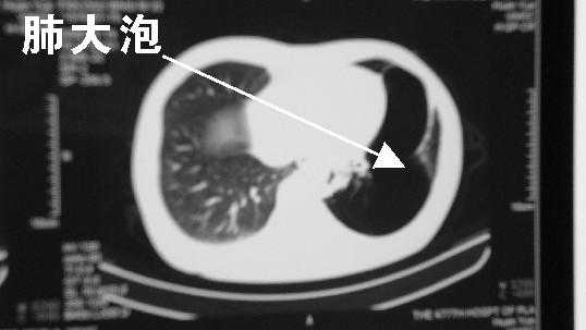 肺大泡吸氧有用吗（肺大泡吸氧可以改善吗）