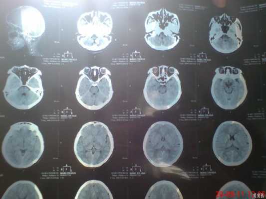 偏头痛CT有用（偏头痛ct检查出来吗）
