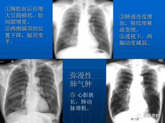 肺部X正面有用还是侧面（肺的正面）