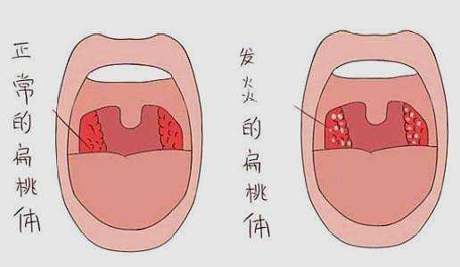 扁桃体有用么（扁桃体有作用吗?）