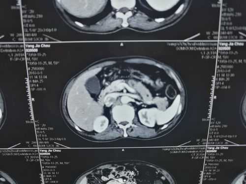 查胰腺做普通CT有用吗（检查胰腺做普通ct可以吗）
