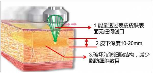 超声波溶脂有用吗（超声溶脂有副作用吗）