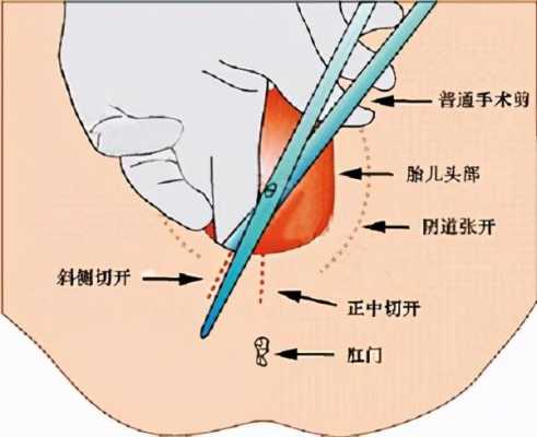 侧切打止疼针有用吗（侧切打止疼针有用吗女性）