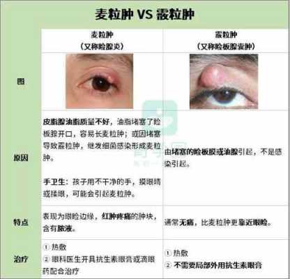 麦粒肿偏方有用么（麦粒肿有偏方吗）