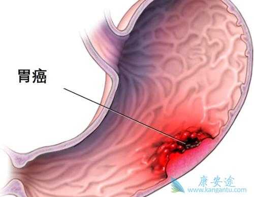 化疗对胃癌晚期有用吗（胃癌晚期化疗会不会加速死亡）