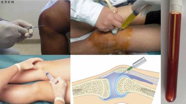 关节穿刺有用那（做关节穿刺需要多少钱）