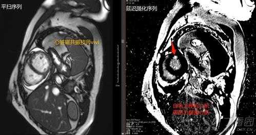 腹胀做磁共振有用吗（腹胀做磁共振有用吗多少钱）