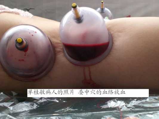 女性腰扭伤放血有用吗（急性腰扭伤的放血疗法）