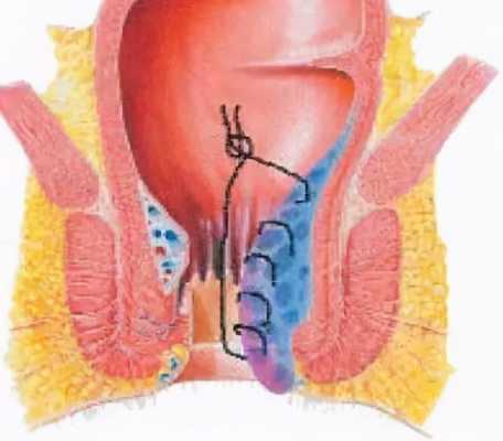内痔结扎术有用吗（内痔结扎手术图解）