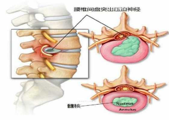 腰椎压迫神经躺着有用吗（腰突压迫神经躺着疼）