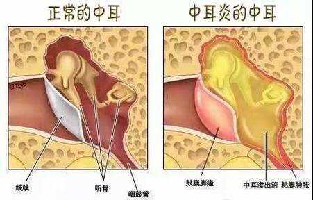 中耳炎能有用吗（中耳炎能治么）