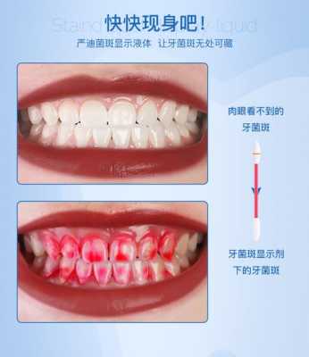 牙菌斑显示剂有用吗（牙菌斑显示剂常用的剂型主要有）