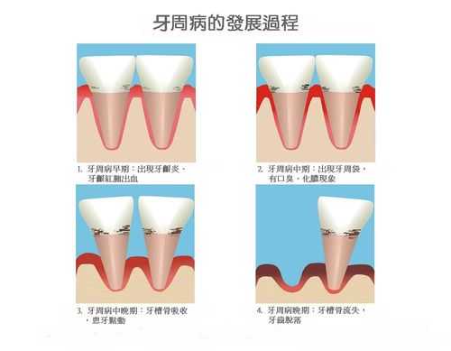 牙周治疗牙周病有用吗（牙周病冶疗）