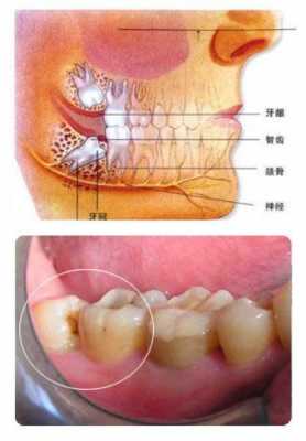为什么智齿没有用（为什么智齿没有用牙膏）