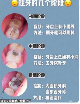 蛀牙有炎症挂水有用么（蛀牙疼打吊瓶消炎有用吗）