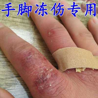 冻疮膏擦手有用吗（冻疮膏抹在手上刺痛）