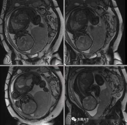 胎盘植入做核磁有用吗（胎盘植入做核磁有用吗知乎）