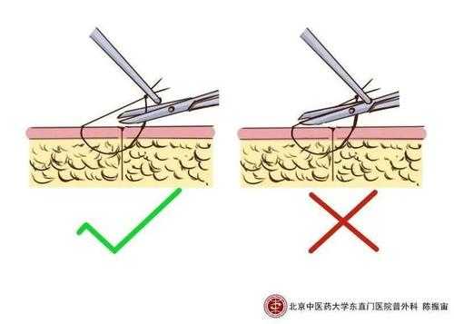 拆线外涂麻药有用吗（拆线可以外敷麻药吗）