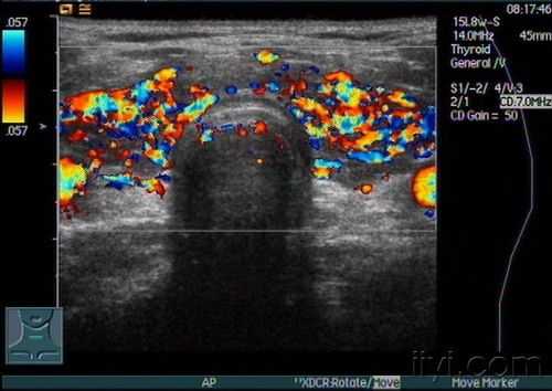 超声修复治疗甲亢有用吗（甲亢超声波）