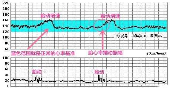 在家胎心监护有用吗（在家胎心监护有用吗知乎）