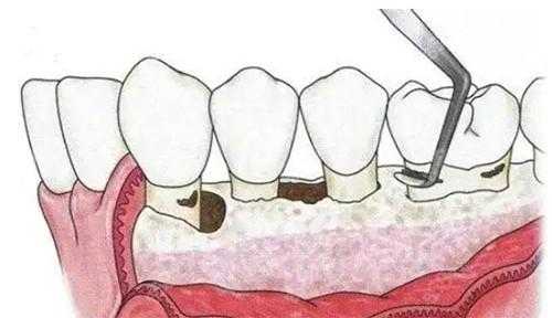 牙周炎龈下刮治有用吗（牙周炎龈下刮治了多久消肿）