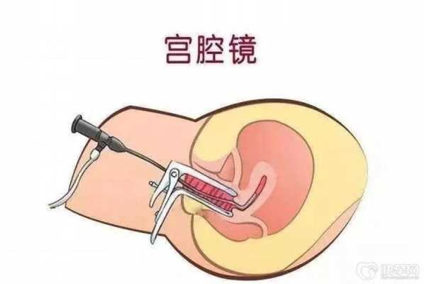 内膜不长做宫腔镜有用吗（内膜不长做宫腔镜有用吗女性）