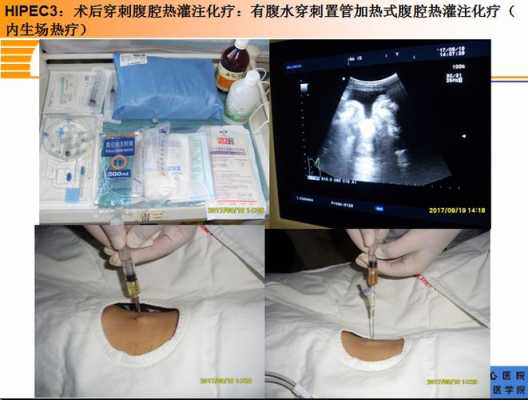 肝癌术后热灌注有用吗（肝癌热灌注化疗效果怎么样）