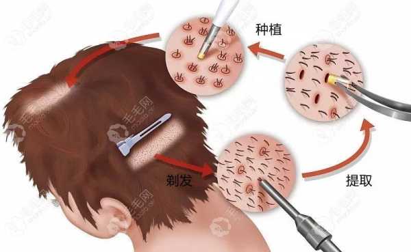 种植毛囊有用么（种植的毛囊会不会洗掉）