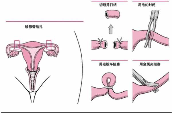 结扎证是假的有用吗（结扎证是假的有用吗知乎）