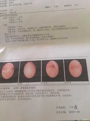 做完宫腔镜对怀孕有用（做宫腔镜后对怀孕有影响吗）