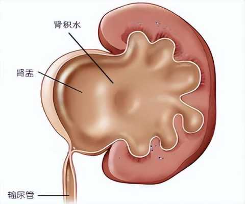 肾盂癌放疗有用吗（肾盂癌放疗3个月后复发症状）