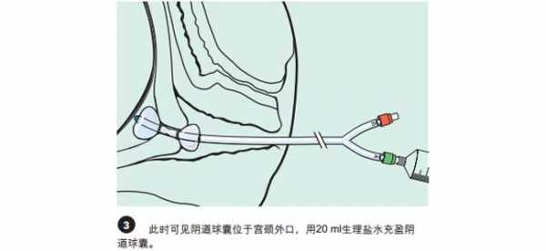 扩宫颈球囊有用吗（宫颈扩张球囊的坏处）